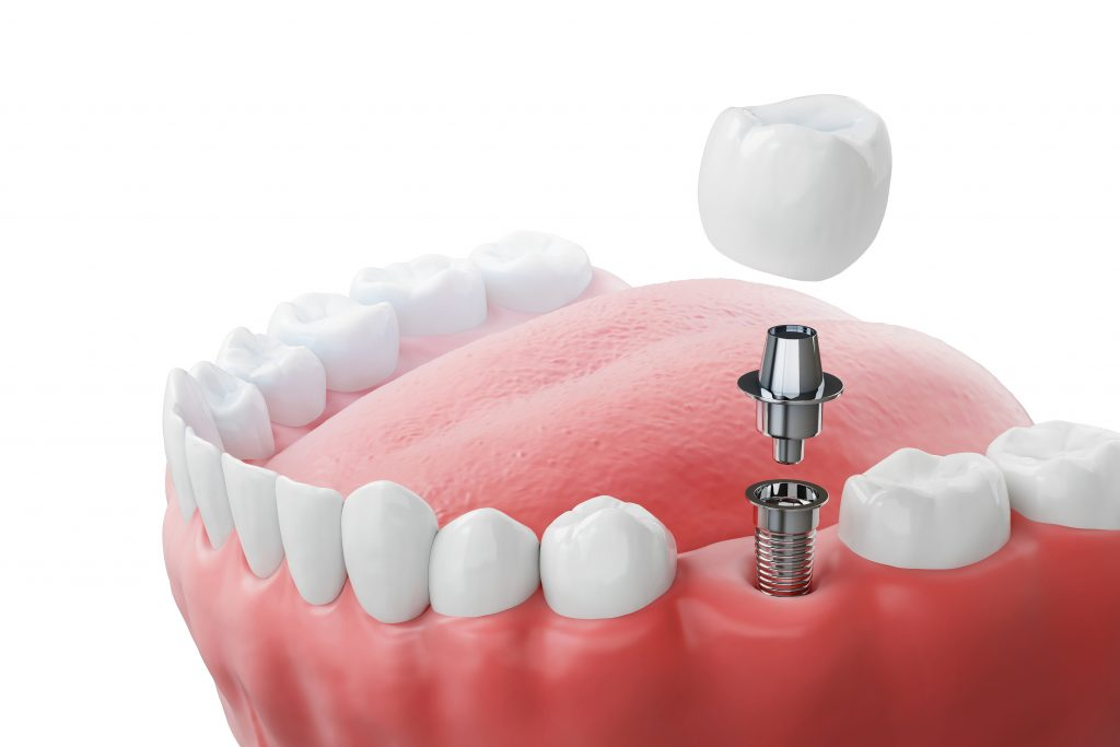 Implante dental — resultado