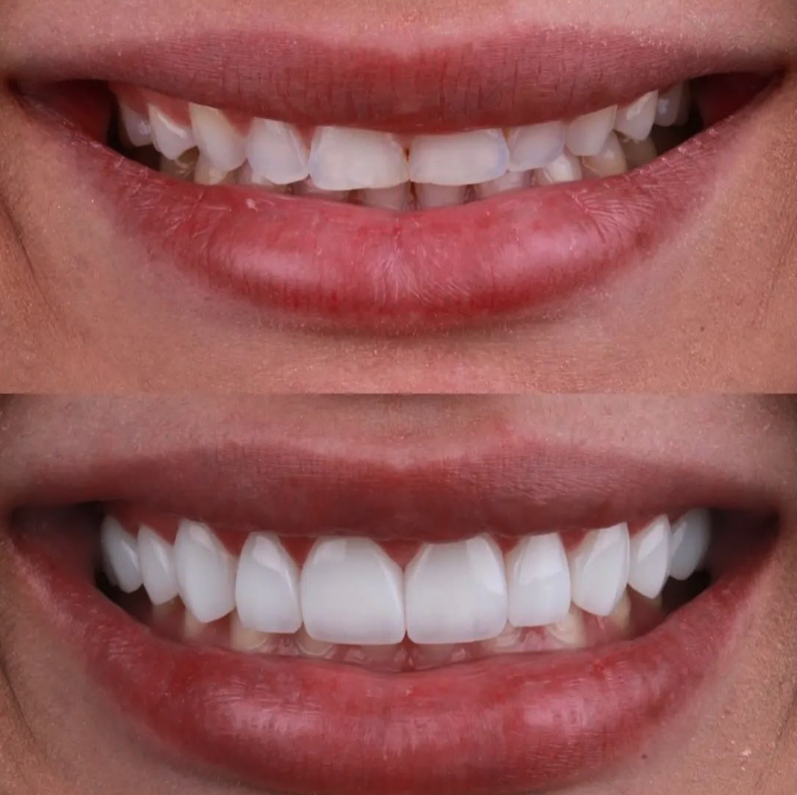 Sorriso com lentes de resina