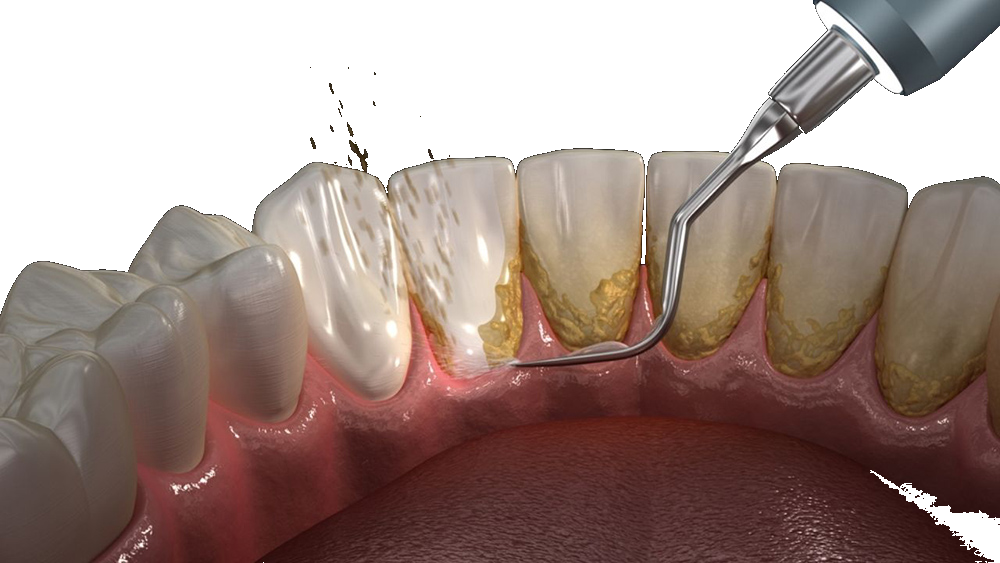 Limpeza dental / profilaxia