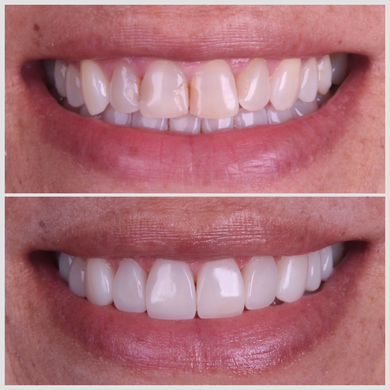 Antes e depois — sorriso transformado