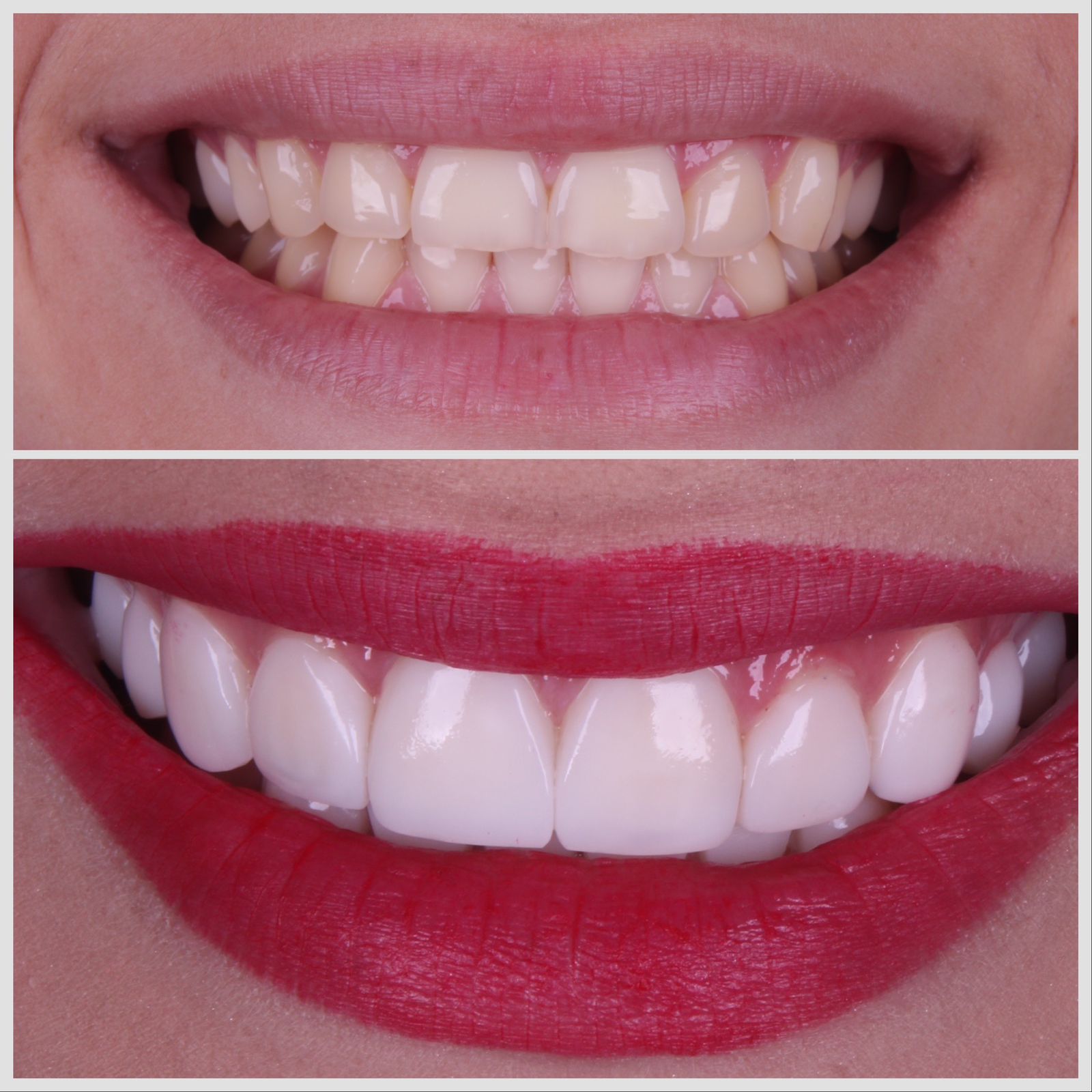 Antes e depois — sorriso transformado