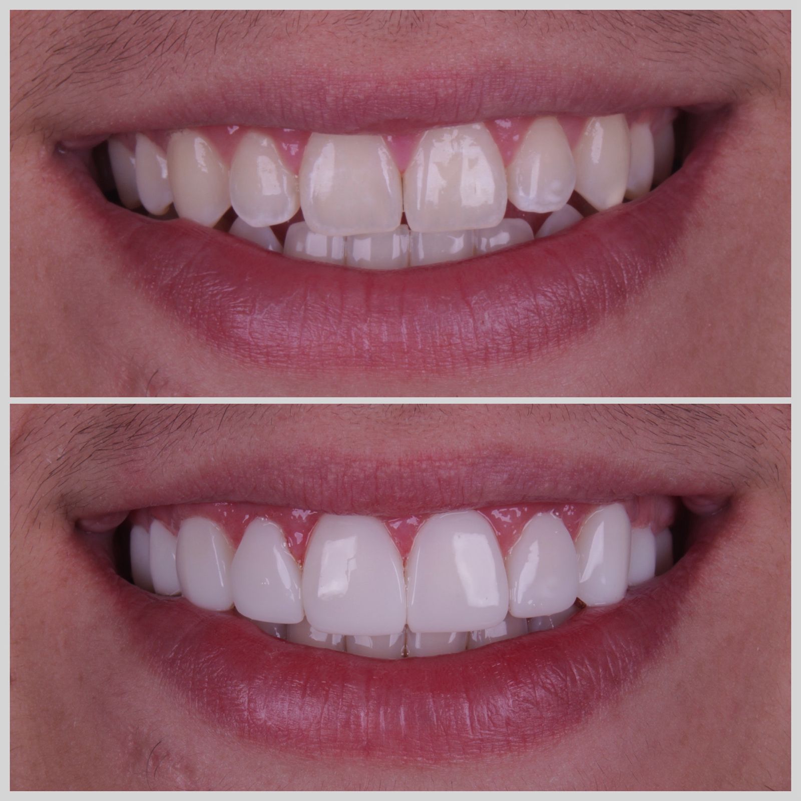 Antes e depois — sorriso transformado