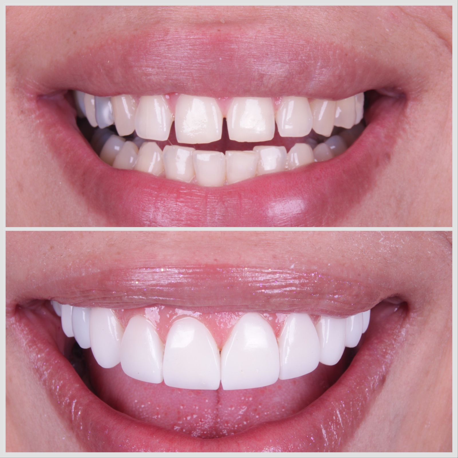 Antes e depois — sorriso transformado