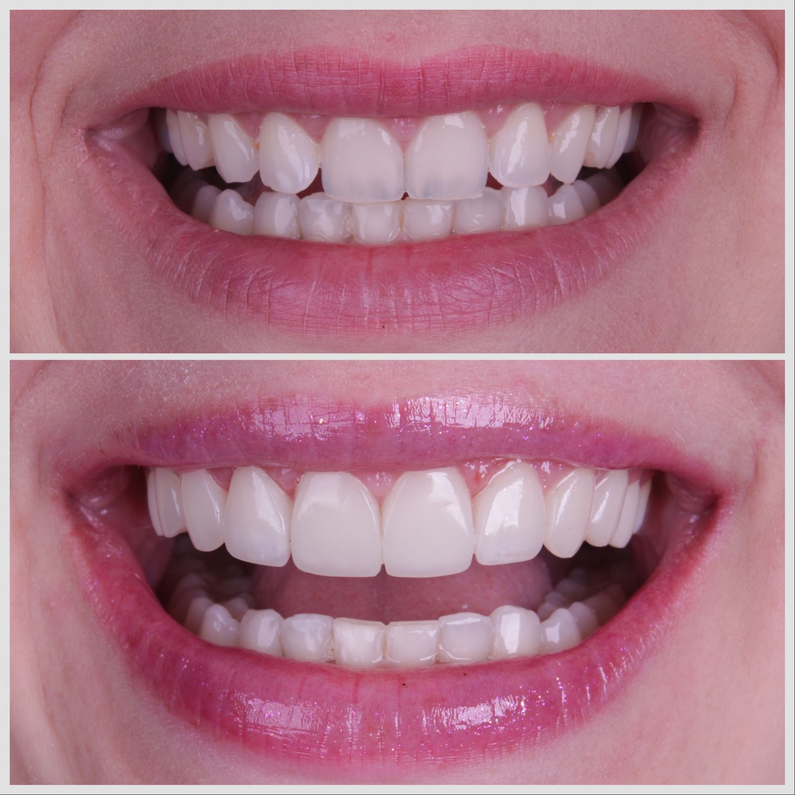 Antes e depois — sorriso transformado