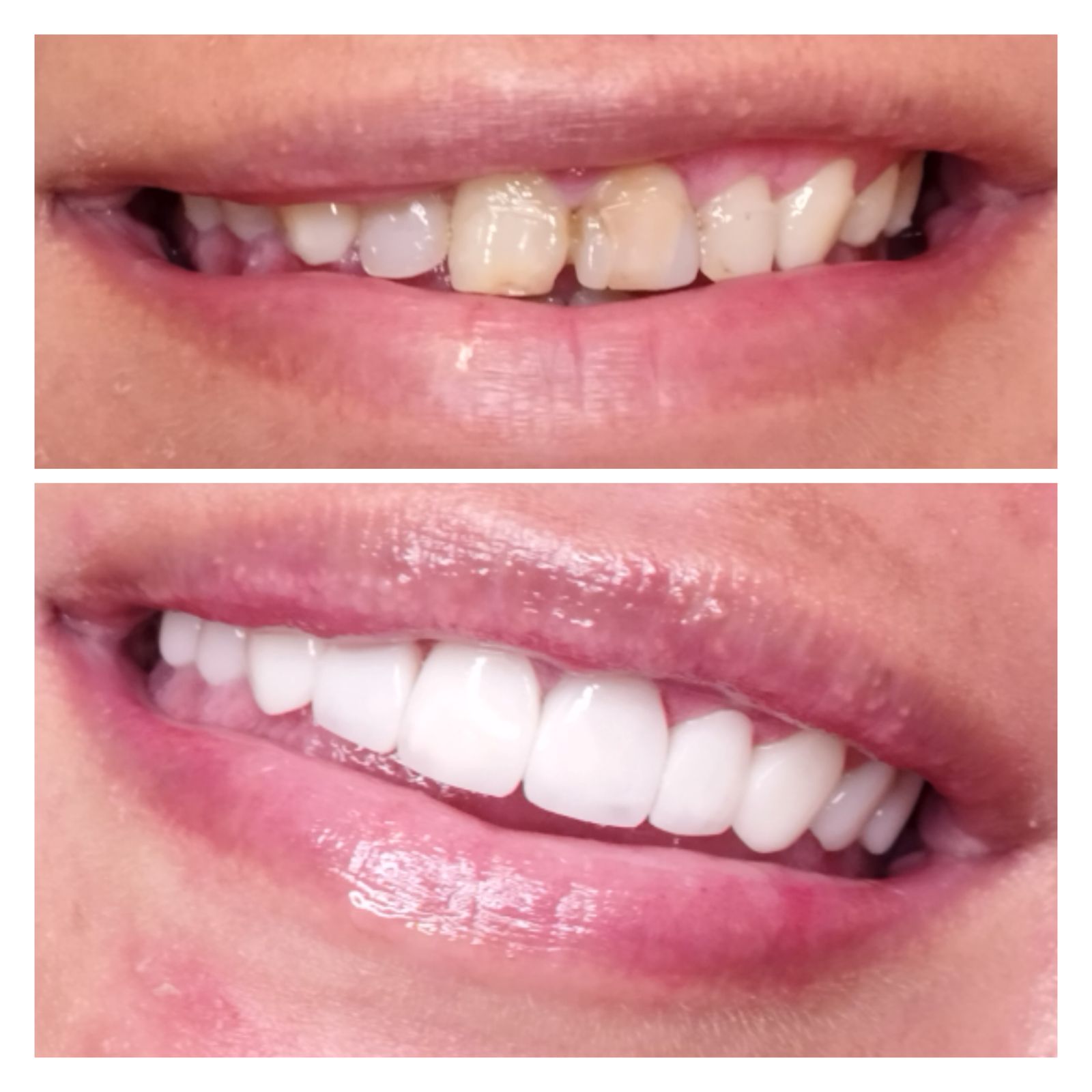 Antes e depois — sorriso transformado