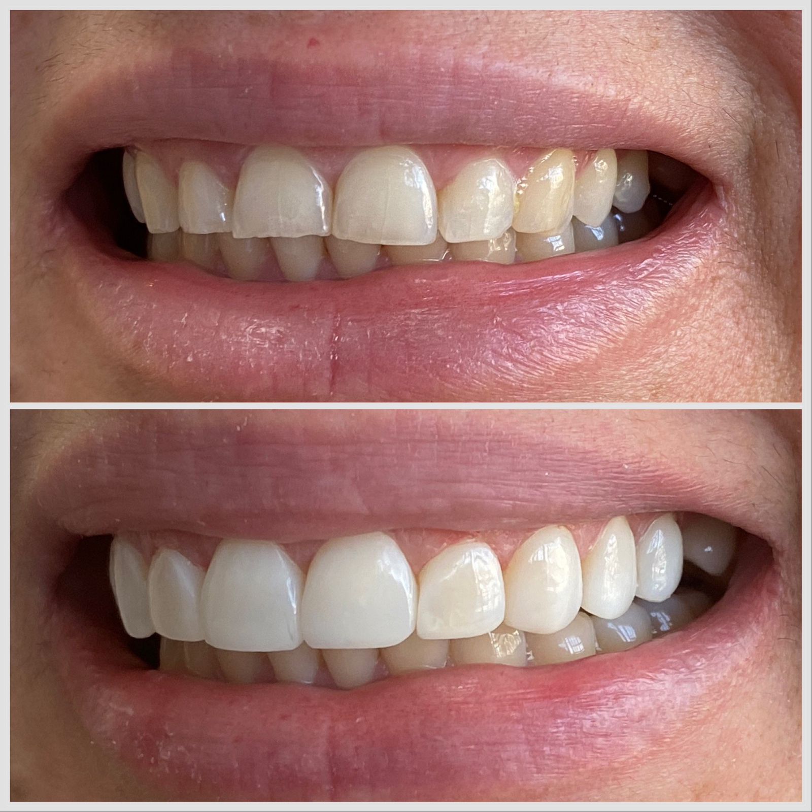 Antes e depois — sorriso transformado