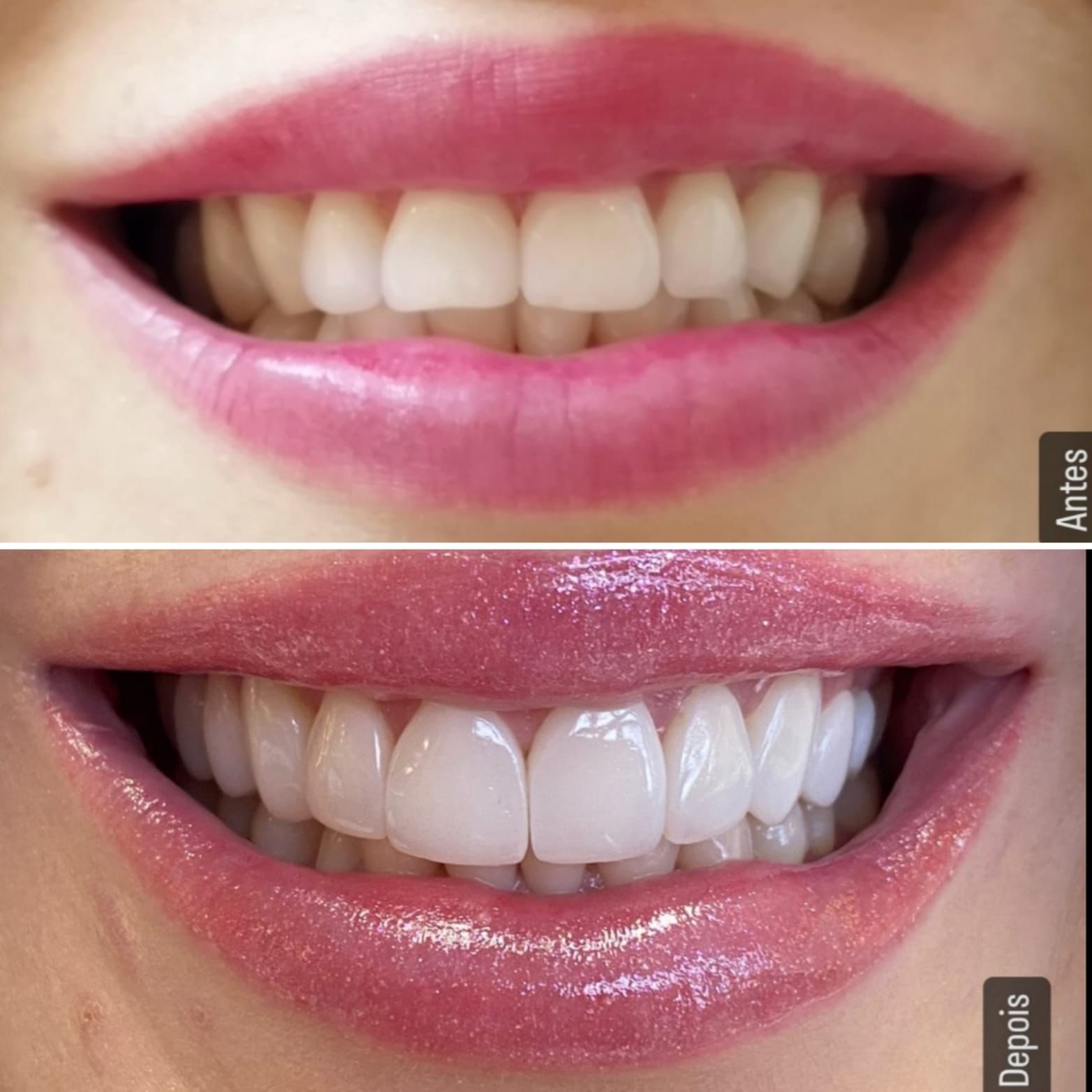 Antes e depois — sorriso transformado