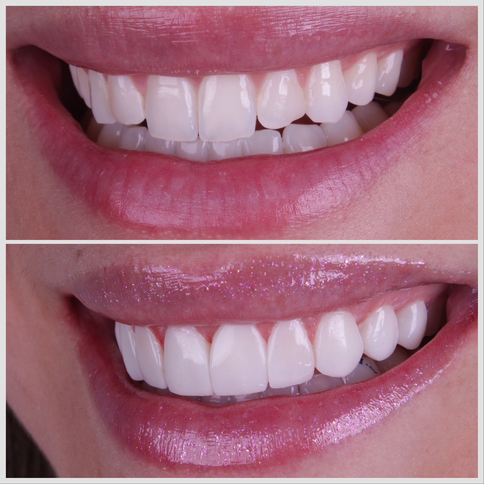 Antes e depois — sorriso transformado