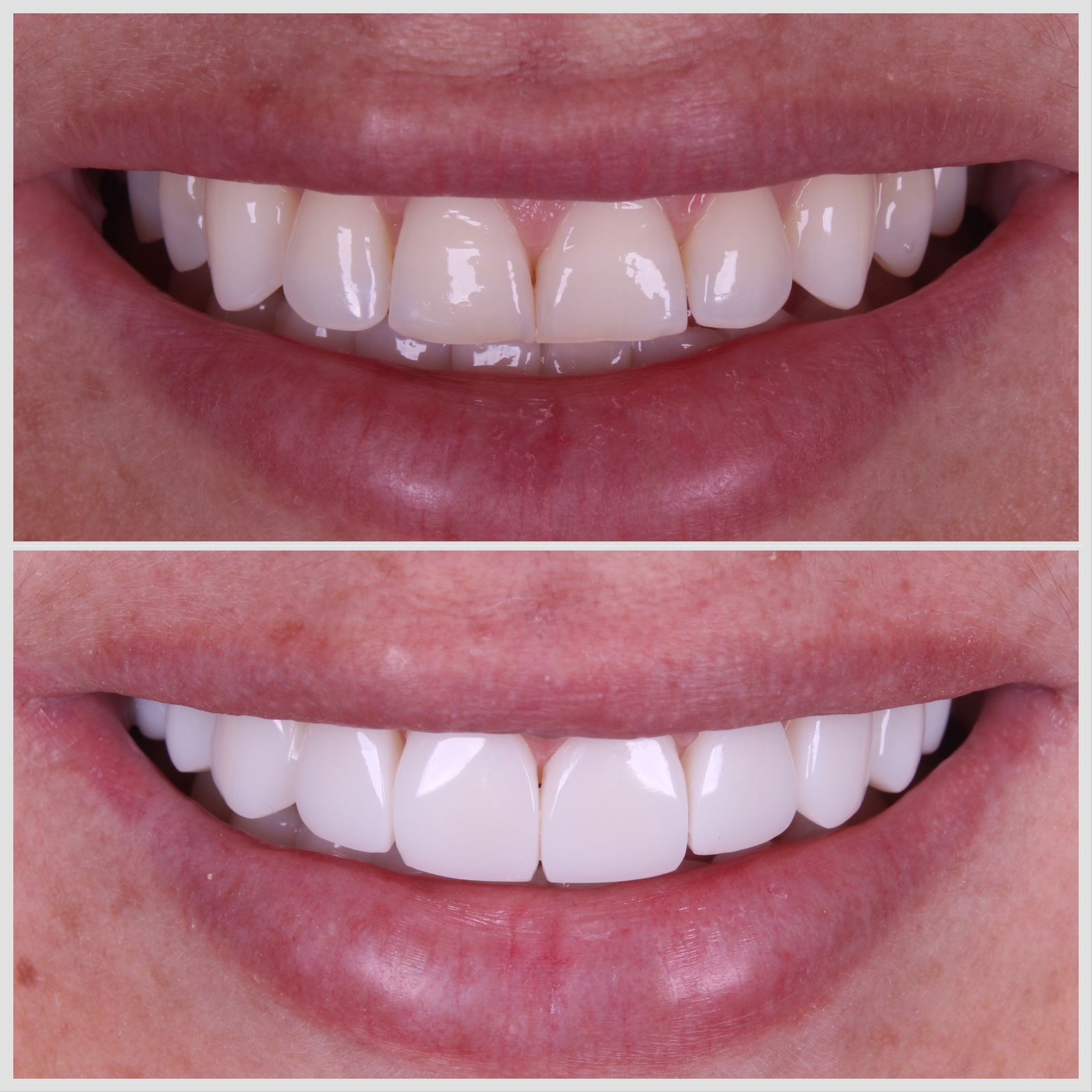 Antes e depois — sorriso transformado