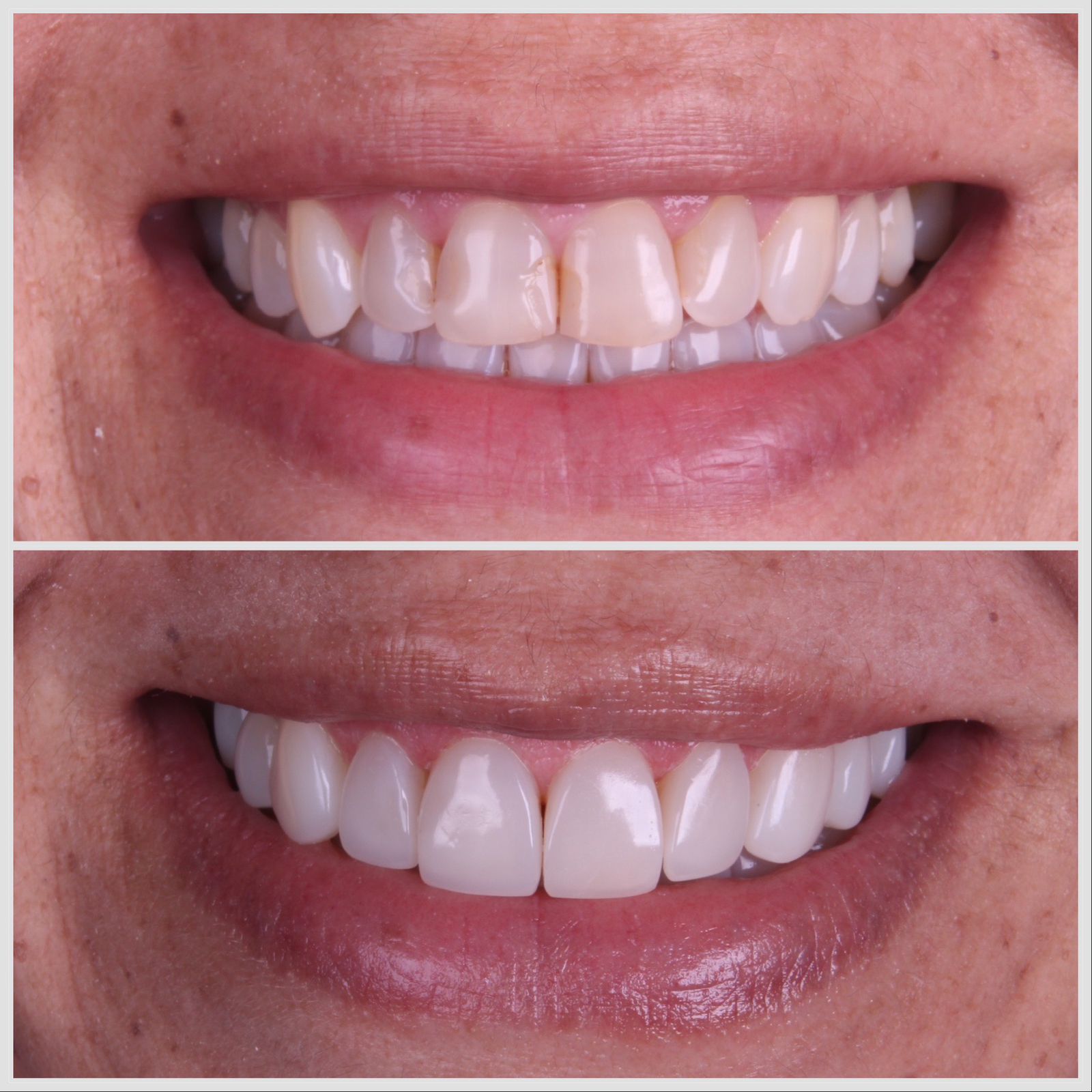 Antes e depois — sorriso transformado