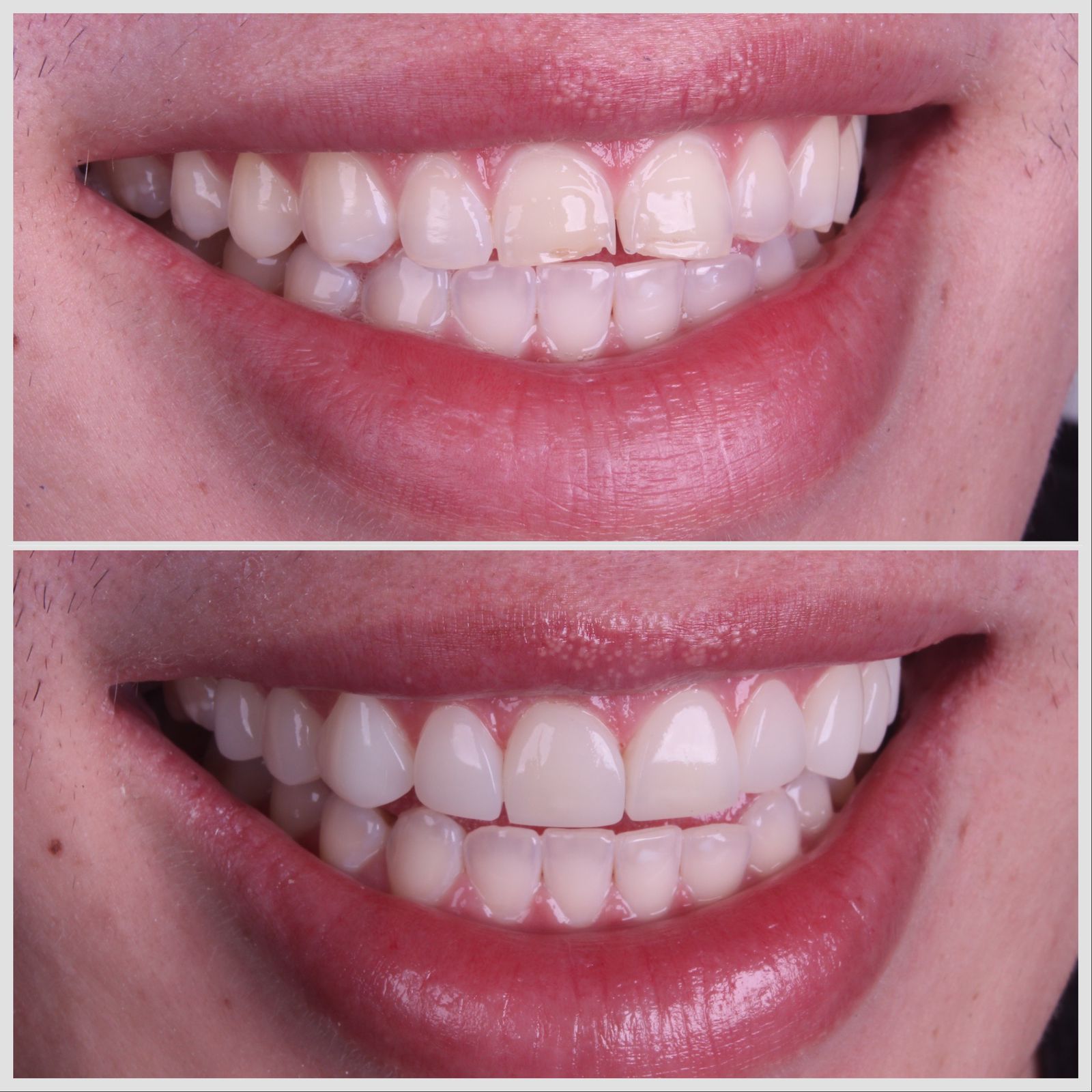 Antes e depois — sorriso transformado