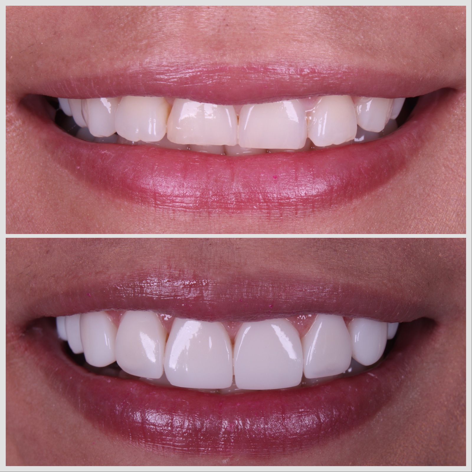 Antes e depois — sorriso transformado
