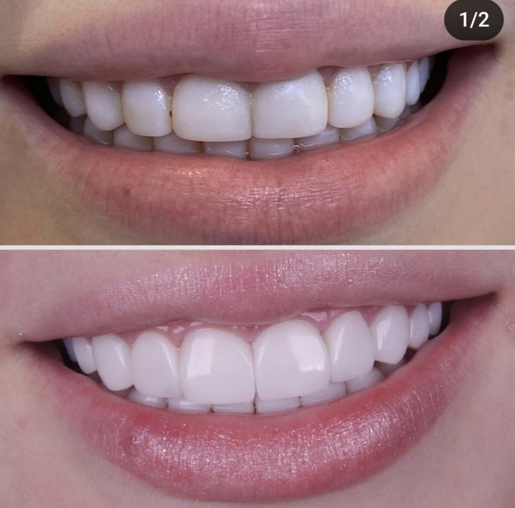Antes e depois — sorriso transformado