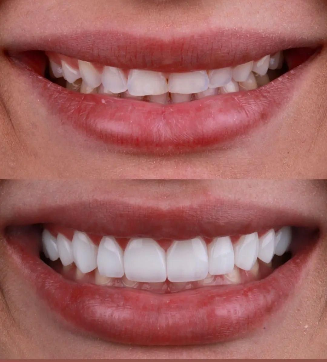 Antes e depois — sorriso transformado