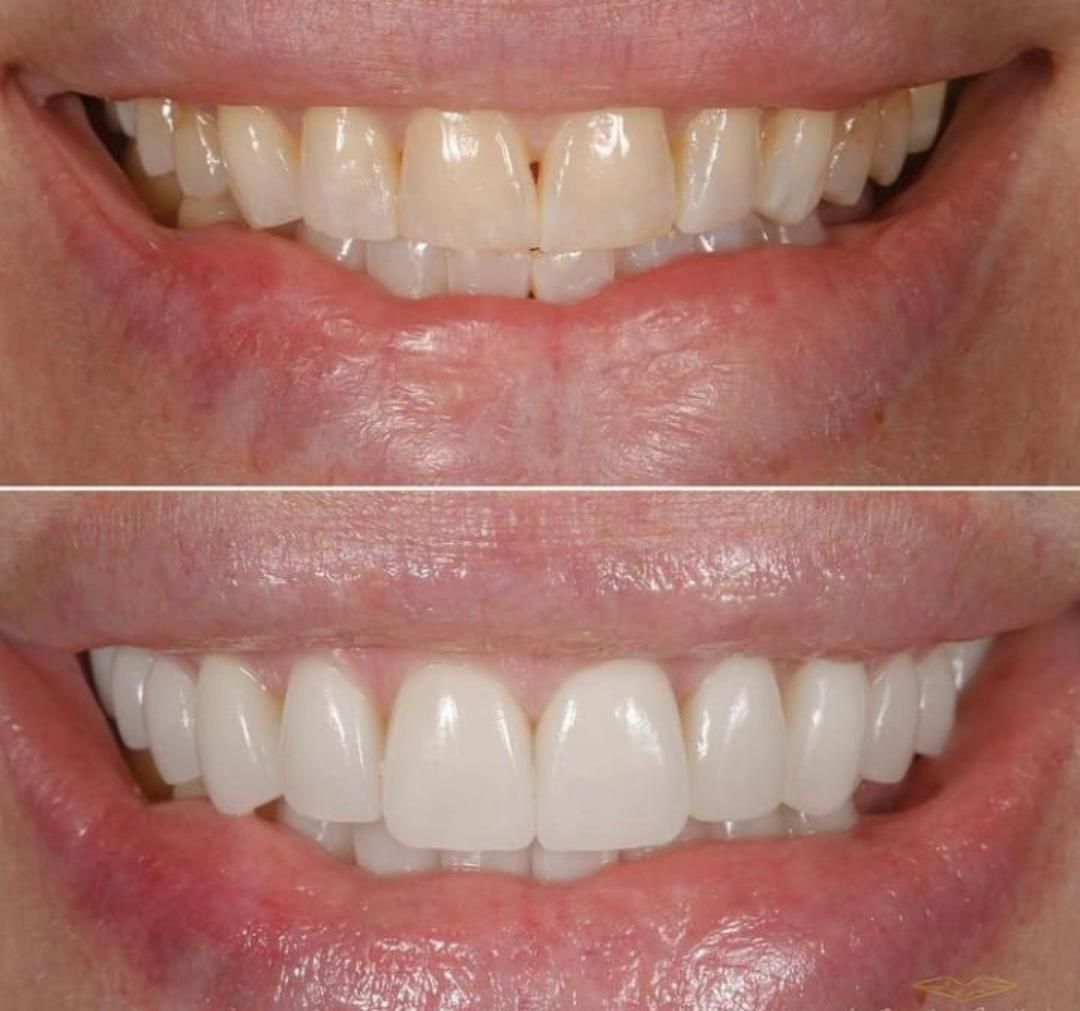 Antes e depois — sorriso transformado