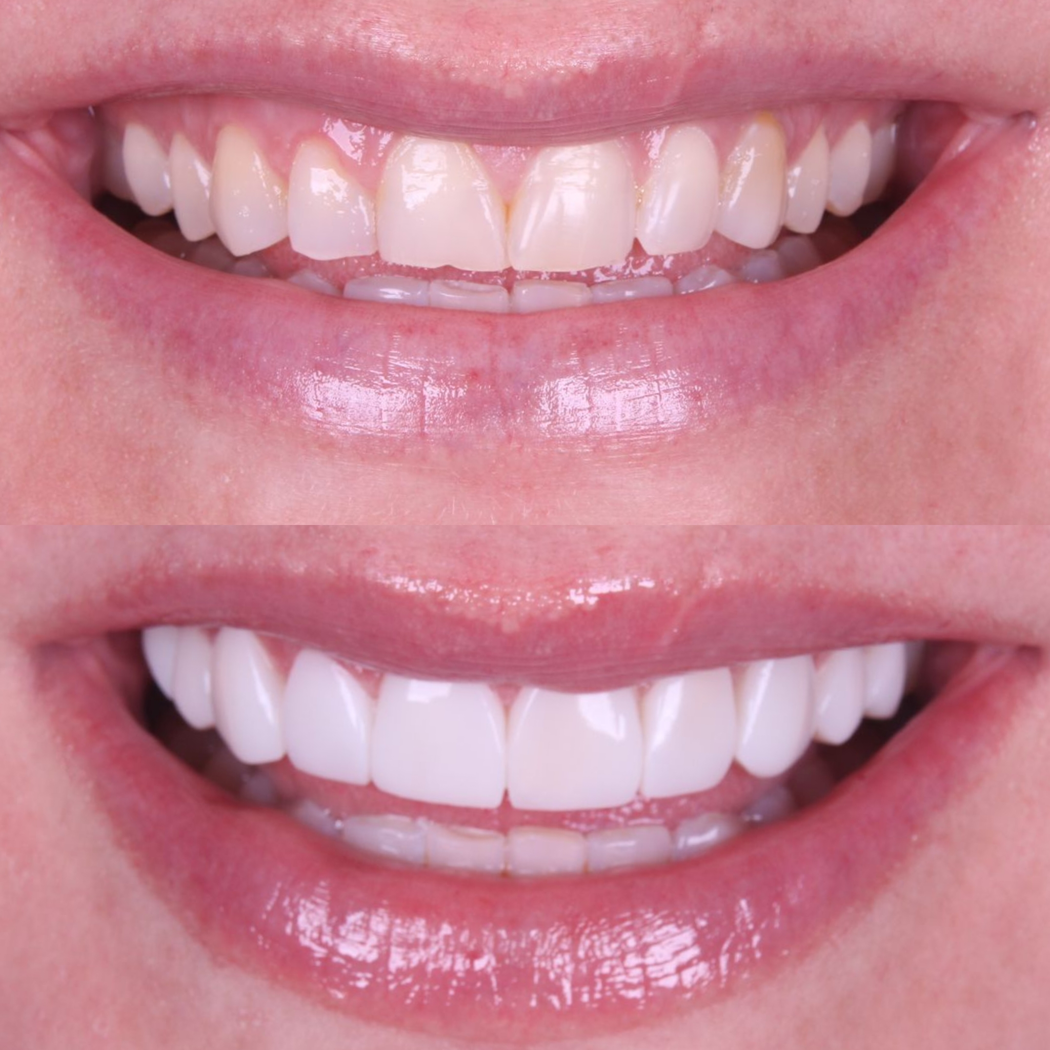 Antes e depois — sorriso transformado