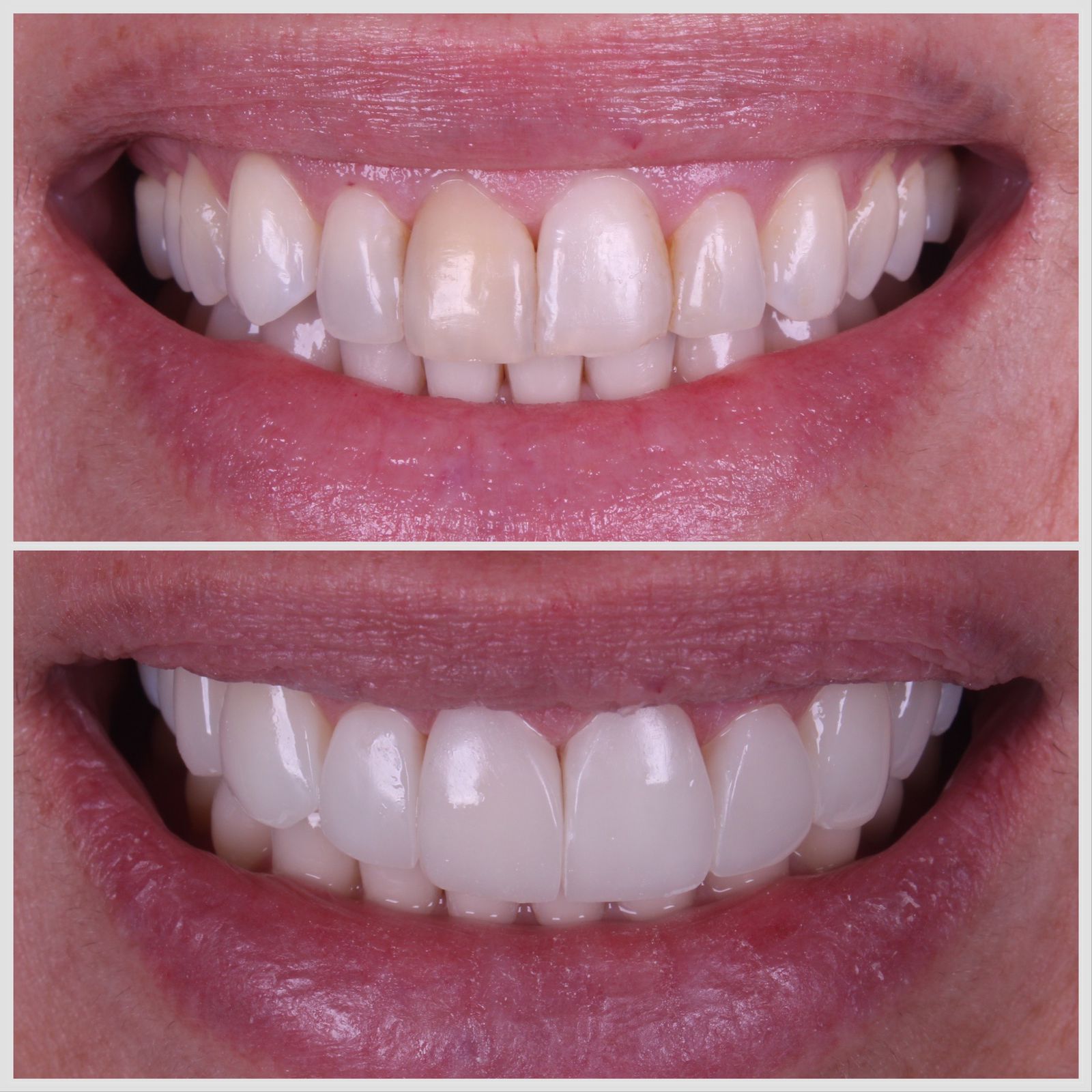 Antes e depois — sorriso transformado