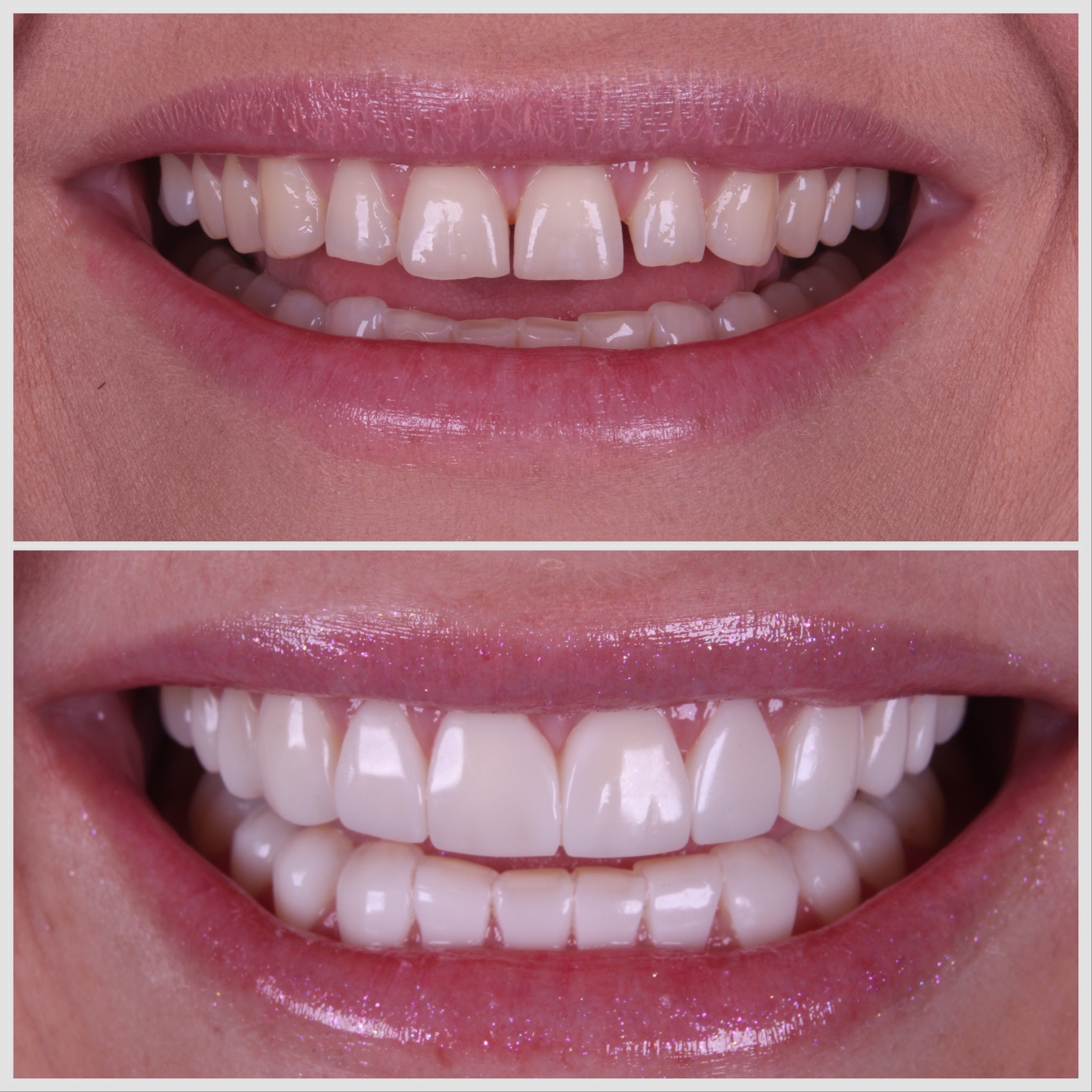 Antes e depois — sorriso transformado